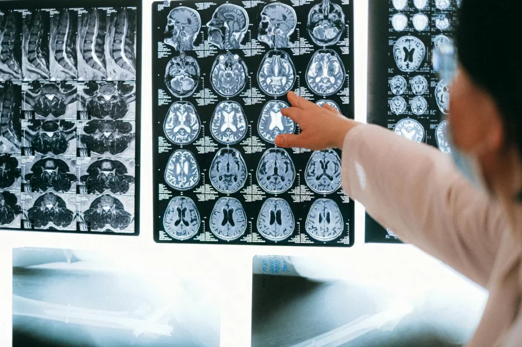 How Anterograde Amnesia Really Works: 7 Evidence-Based Answers Radiologist reviewing brain MRI scans to explain how does anterograde amnesia work in medical diagnosis