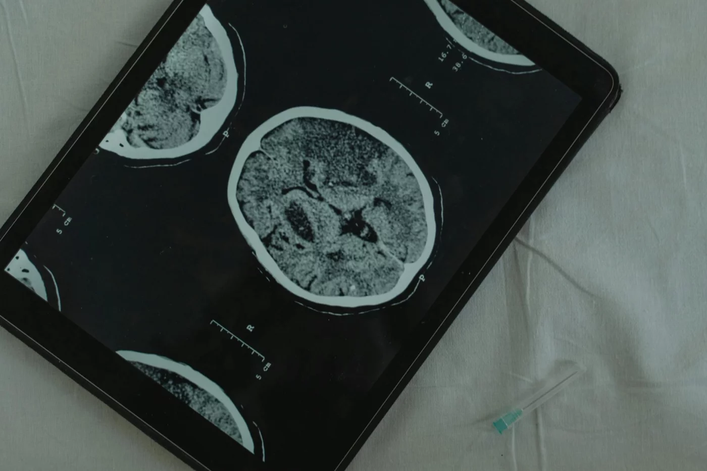 Brain CT scan on a tablet illustrating addicted brain vs normal brain and the potential for healing after addiction